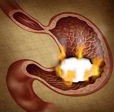 Stomach ulcer Illustrazione stock