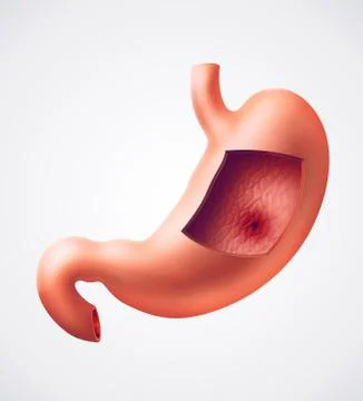 Stomach ulcer Stock Illustration