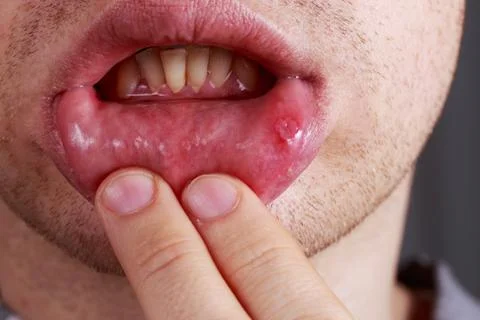 Stomatitis on the lips Stockfoto's