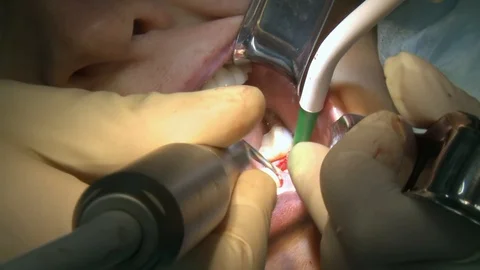 Stomatologist do removal of caries on teeth a patient in modern office clinic 스톡 동영상 118801312