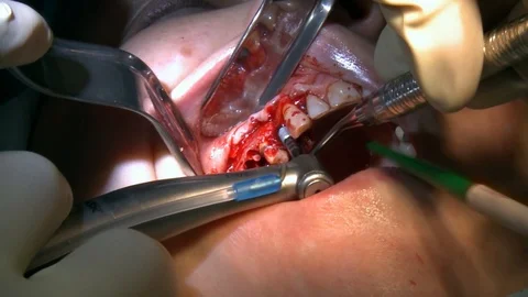 Stomatologist do tooth extraction a patient in modern office clinic operating Video stock 118801329