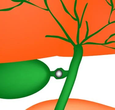 Stone bile duct. Gallbladder, duodenum, pancreas, bile ducts. Vector Stock Illustration