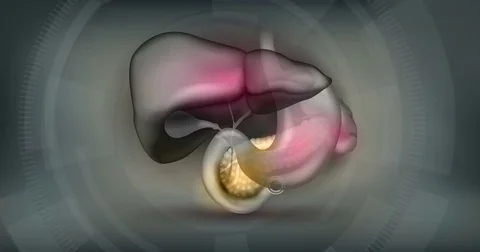 Stones in the Gallbladder and pain Stock Footage 71298866