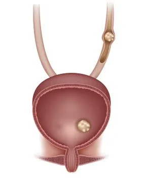 Stones in the urinary system Stock Illustration