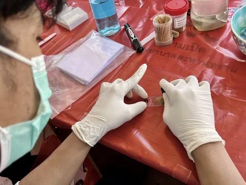 Stool exam, Stool test, Stool examination,OVCCA 스톡 사진