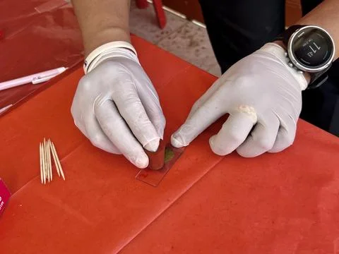 Stool exam, Stool test, Stool examination,OVCCA 스톡 사진