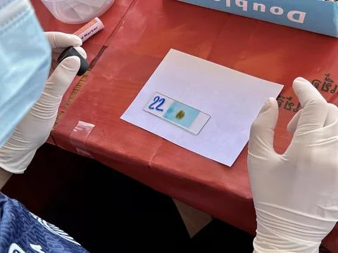 Stool exam, Stool test, Stool examination,OVCCA Foto stock