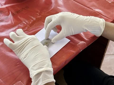 Stool exam, Stool test, Stool examination,OVCCA Stock-Fotos