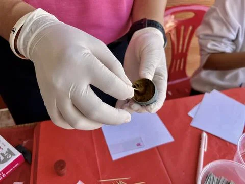 Stool exam, Stool test, Stool examination,OVCCA 스톡 사진