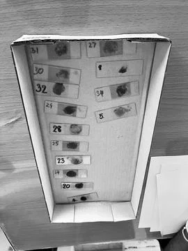 Stool exam, Stool test, Stool examination,OVCCA 스톡 사진