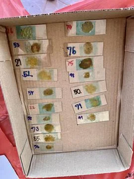 Stool exam, Stool test, Stool examination,OVCCA Foto stock