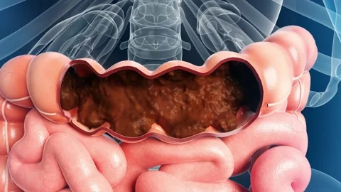 Stool remains in rectum, unable to discharge. Stockbeeldmateriaal 344102599