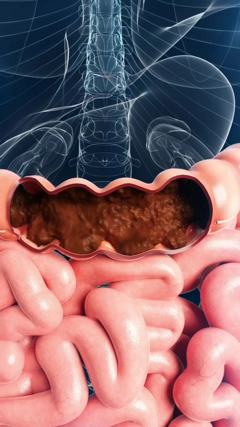 Stool retention in rectum, slow peristalsis, toxin accumulation. 스톡 동영상 344102574