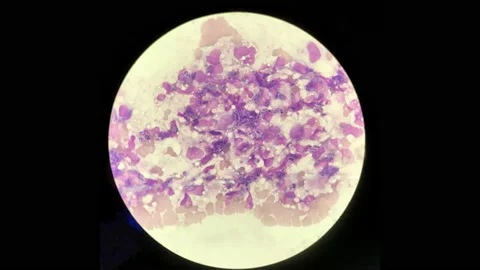 Stop motion VDO Yeast cells phagocytosis by white blood cell in blood smear. Stock Footage 130356327