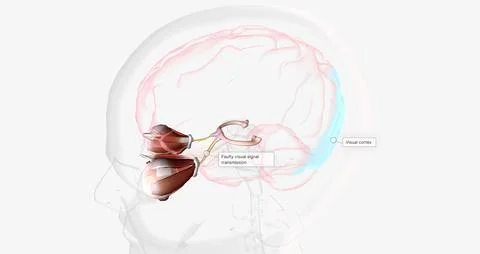 Strabismic Amblyopia, Visual Pathway with Eye Movement Stock Illustration
