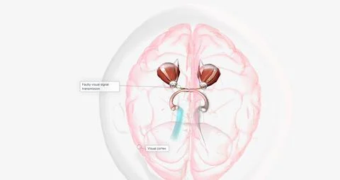 Strabismic Amblyopia, Visual Pathway with Eye Movement Stock Illustration