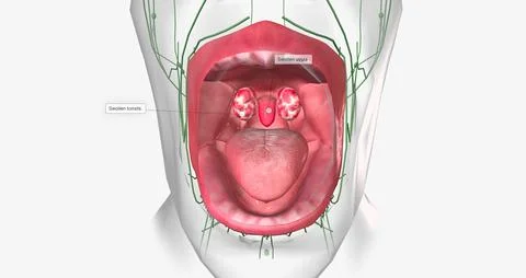Strep throat is a common condition caused by a bacterial infection of the mou Stock Illustration