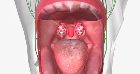 Strep throat is a common condition caused by a bacterial infection of the mou Stock Illustration
