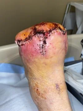 Streptococcal Cellulitis of Left Transmetatarsal Amputation Stump Stock Photos