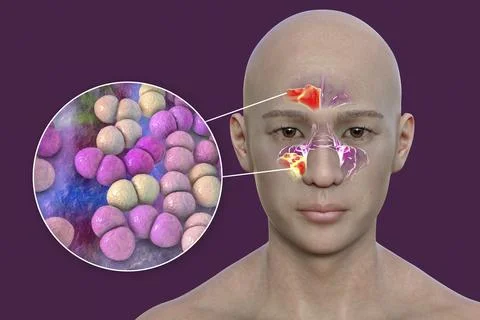 Streptococcus pneumoniae bacteria as a cause of sinusitis, 3D illustration Stock Illustration