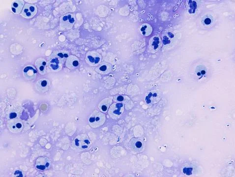 Streptococcus pneumoniae meningitis CSF Stock Illustration