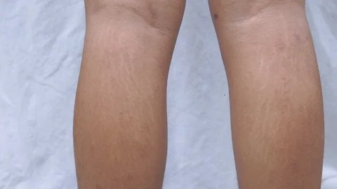 Stretch mark at leg Video stock 101857235