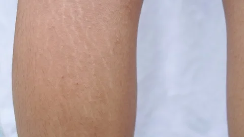 Stretch mark at leg Video stock 101857286