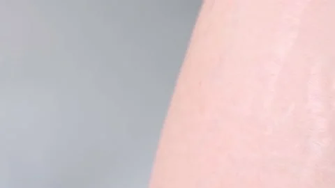 Stretch marks on the body due to weight loss and sagging skin. Stock Footage 154330549