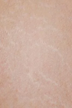 Stretch marks on human skin Stock Photos