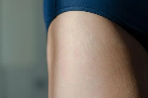 Stretch marks on legs after weight loss close up. Skin care. Stock Photos