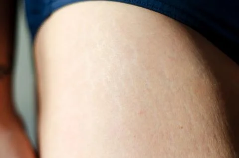 Stretch marks on legs after weight loss close up. Skin care. Stock Photos