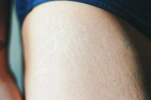 Stretch marks on legs after weight loss close up. Skin care. Stock Photos