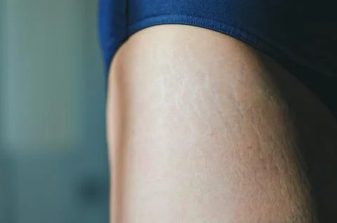 Stretch marks on legs after weight loss close up. Skin care. Stock Photos
