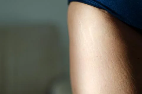 Stretch marks on legs after weight loss close up. Skin care. Stock Photos
