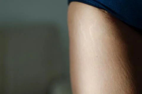 Stretch marks on legs after weight loss close up. Skin care. Stock Photos