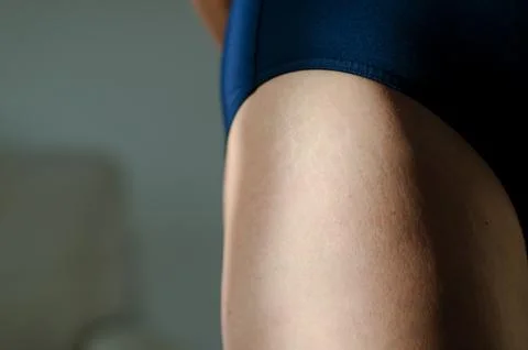 Stretch marks on legs after weight loss close up. Skin care. Stock Photos
