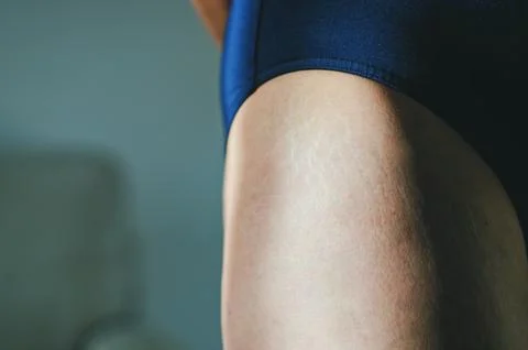 Stretch marks on legs after weight loss close up. Skin care. Stock Photos