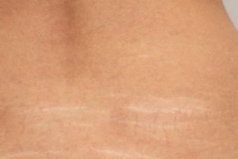 Stretch marks on the lower back Stock Photos