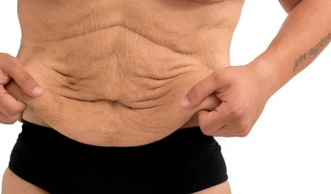 Stretch marks of a man after  weight loss Stock Photos