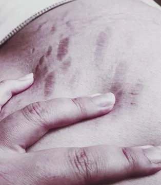 Stretch Marks Stock-Fotos