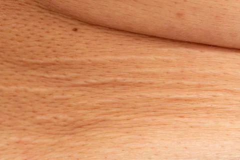 Stretch marks on the skin as a background. Stock Photos