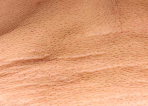 Stretch marks on the skin in the form of stripes as a background Stock Photos