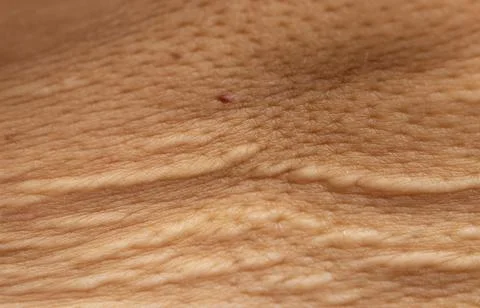 Stretch marks on the skin in the form of stripes as a background Stock Photos