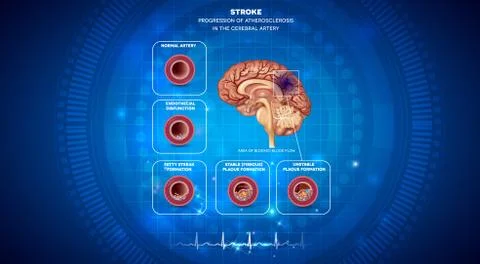 Stroke, blood clot formation in the brain Stock Illustration