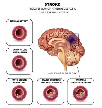 Stroke in the brain artery Stock Illustration
