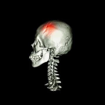 Stroke . CT scan with 3D image of human skull and cervical spine Illustrazione stock