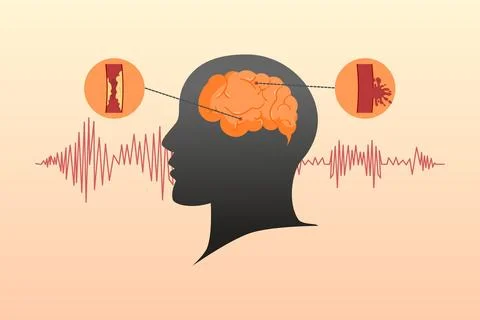 Stroke disease concept. Ischemic and hemorrhagic. Stock Illustration