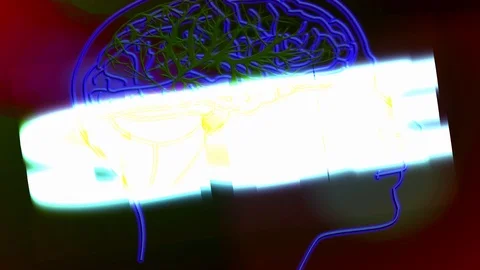 Stroke with a human brain Stock Footage 123564555