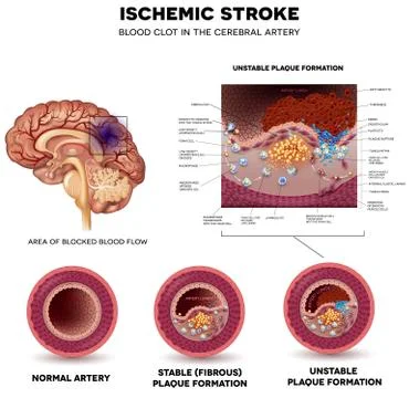 Stroke Stock Illustration