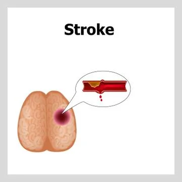 Stroke. The structure of the brain. Vascular rupture. World Stroke Day Stock Illustration